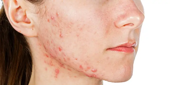 image showing acne in girl's face due to PMS