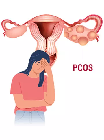 PCOS