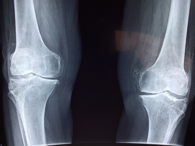 Bone-calcium loss is due to menopause?